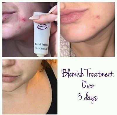 Tratament acnee, puncte negre – Epoch Blemish 3